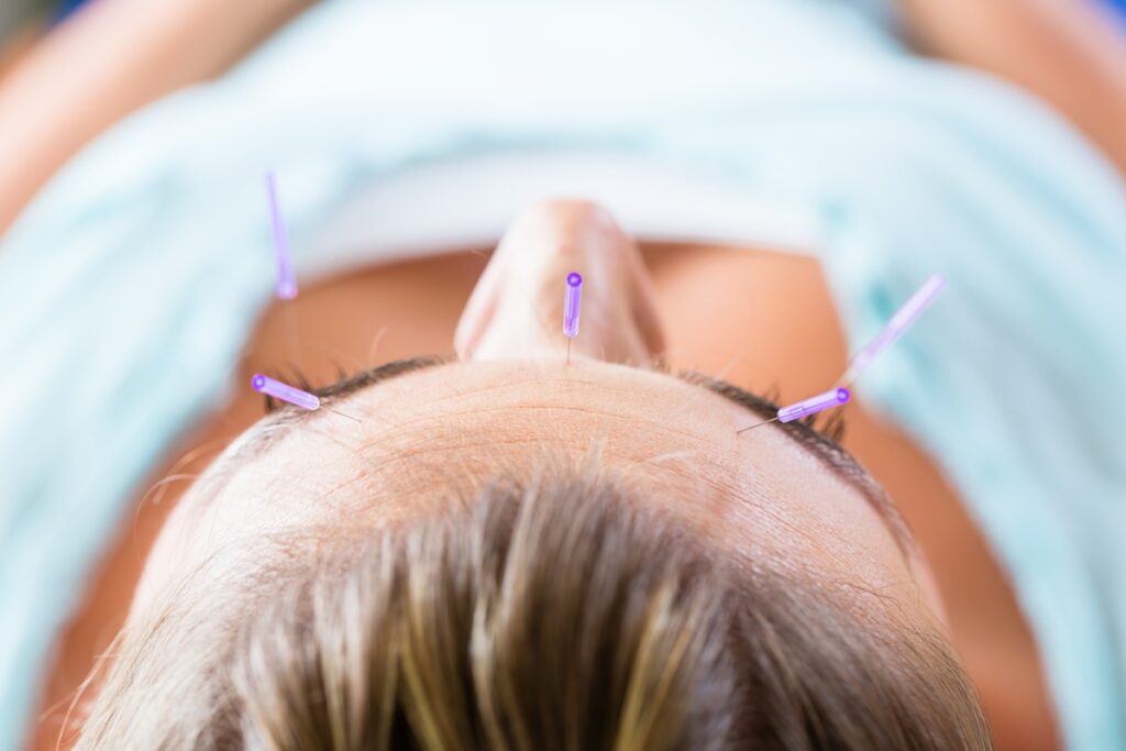 akupunktura łagodzenie bólu porodowego