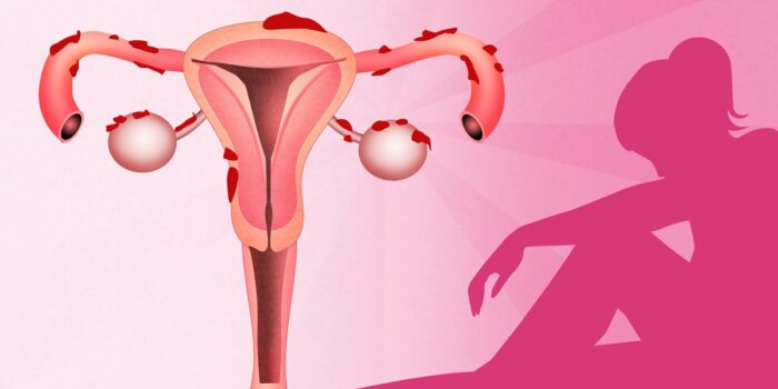 Dieta łagodząca dolegliwości endometriozy