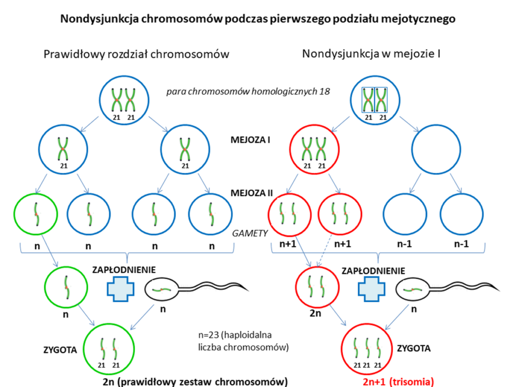 zespół downa. trisomia prosta 21. Nondysjunkcja chromosomów podczas pierwszego podziału mejotycznego