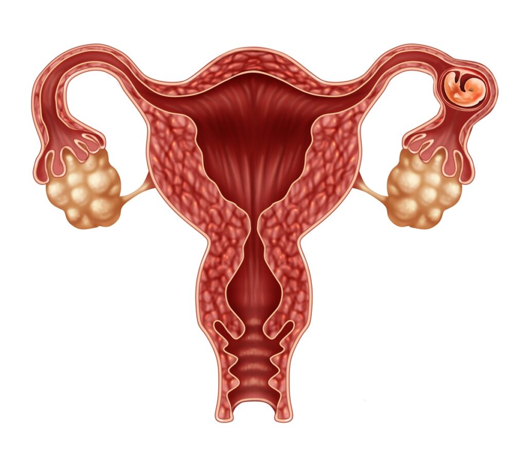 ciąża pozamaciczna umiejscowienie
