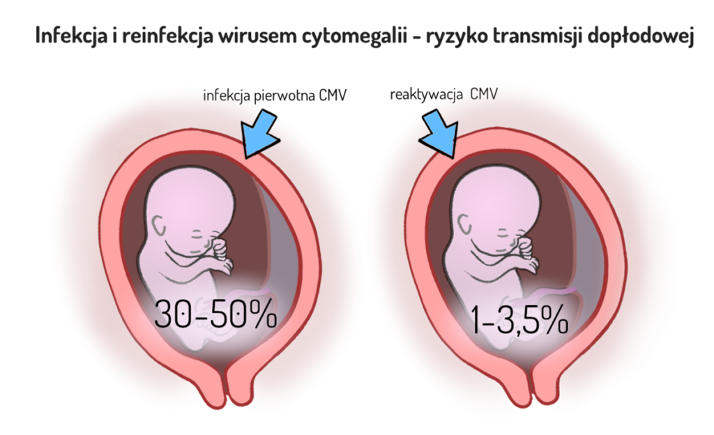 cytomegalia w ciąży